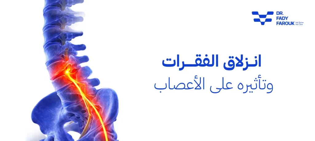 انزلاق الفقرات